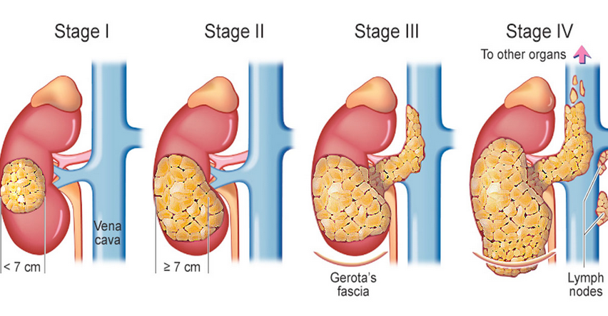 7 Body Changes After Kidney Cancer That 99% People Mistake as Normal